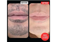 エヌクリア(N CLEAR)/メンズ髭脱毛　爆抜けモード搭載