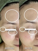 サロンドジェシカ(salon de Jessica)/プラズマフェイシャル