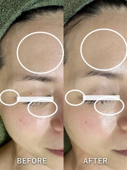 サロンドジェシカ(salon de Jessica)/プラズマフェイシャル