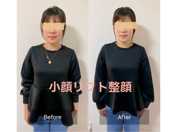 チル(Chill.)/小顔リフト整顔 7