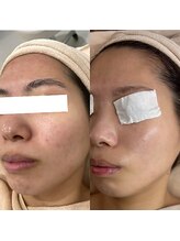 お肌想いラボ/【ニキビ・赤み改善】