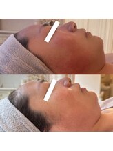 ナル(naru.)/臍帯9回で赤ら顔ケア