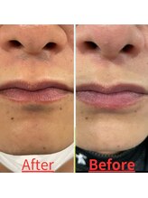 トミー(TOMMY)/2年間通って残ってしまったお髭