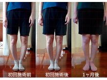 よしだ整体院/O脚矯正