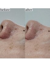 ヴェルシック(Belchic)/どうしても気になる鼻の毛穴