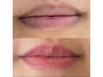 アンヘル(Angel)/ローマピンク　ビフォーアフター