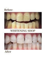 ホワイトニングショップ 岸和田店/お客様のBefore  After