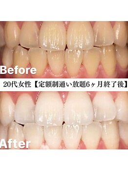 ホワイト 福岡天神店(WHITE)/ホワイトニングビフォーアフター