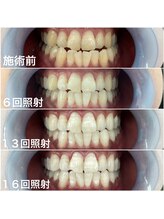 ホワイトニングサロン 京都烏丸店/ホワイトニング施術例