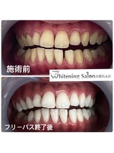 ホワイトニングサロン 京都烏丸店/ホワイトニング施術例