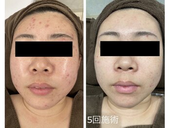 チャマ 高知店(CHAMA)/20代 ニキビ