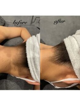 アンジー(an.g)/【福山市脱毛】うなじ脱毛