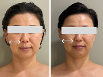 マグノリア/小顔パルス美容鍼