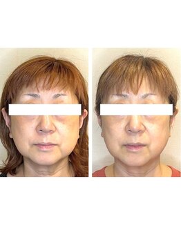 ビーサロン(B-salon)/フェイスライン/小顔コルギ