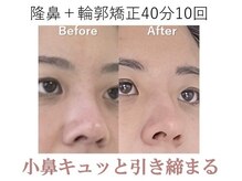 ラプリボヤージュ 藤沢店(Raplit)/ 隆鼻＋輪郭矯正40分10回コース