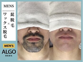 アルゴ 柳川店(ALGO)/アルゴ式！！WAX×光脱毛