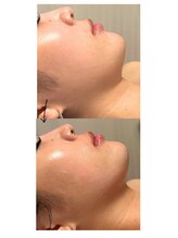 サロンドエムジョリー 横浜(Salon de M jolie)/顔のハリやタルミにお悩みな方！