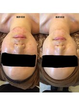 ディア スプリーマ/大人気♪肌分析フェイシャル☆