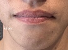 オアシスラグーン(OASIS LAGOON)/メンズ脱毛（症例１：after）