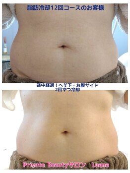 ルアナ(Luana)/大人気の脂肪冷却で痩せる！