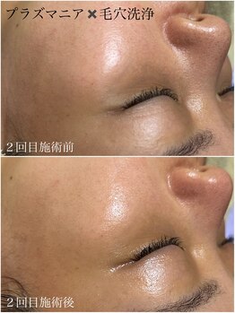 エステルーム クリスタル/【NEW】プラズマニア×毛穴洗浄 