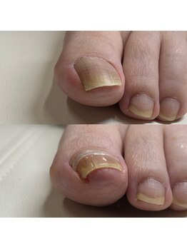 リリ(lili)/巻き爪矯正/1回目