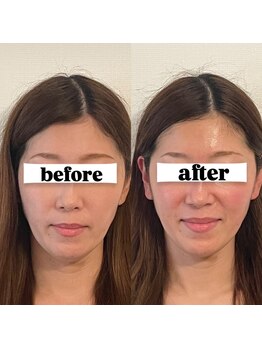 キプラ 福津店(KIPURA)/40代 小顔矯正+リジュラン