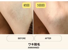 アンマンドの雰囲気（ワキ脱毛3回目でもしっかり抜けます！！）