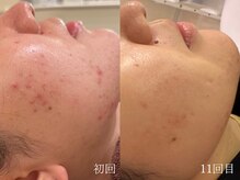 ウォーム(warm)/ニキビケア/肌荒れ/ニキビ肌