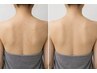 【男女OK★背中 or 太もも裏ヒップ】IPL光ケア¥7000→¥5000