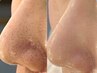 【実感！毛穴洗浄】白ニキビ・ザラつき・皮脂浮き・毛穴スッキリ★90分