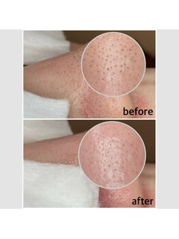 毛穴専科/韓国肌管理◇ 学割u24あり