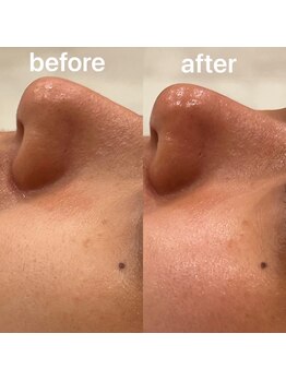 ココ(Coco)/剥離なしハーブピーリング