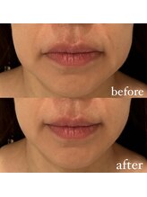 アンヴィウラ/顔筋！小顔フェイシャル