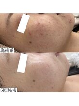 ヴェルシック(Belchic)/くり返しできるフェイスライン