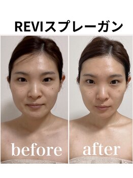 小顔アンドエイジングケア専門店 ビゼ(美sser)/REVIスプレーガン