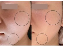 アイビ(愛美)/光フェイシャル