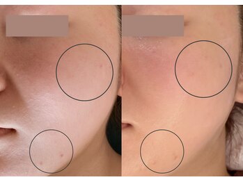 アイビ(愛美)/光フェイシャル