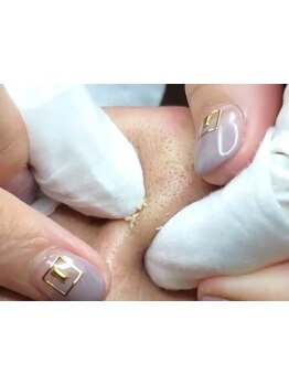 毛穴ケアをしたい