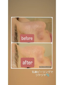 フェローズリンパケア(FELLOWS)/ピーリング