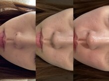 スウィート リリー(Sweet Lily)/エステ版ダーマ