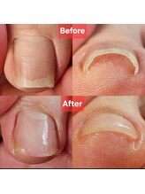 エムズリネイル(M’srenail)/巻き爪補正