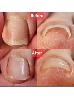 エムズリネイル(M’srenail)/巻き爪補正