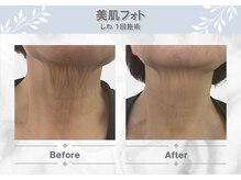 セルフクリア(SELF CLEAR)/