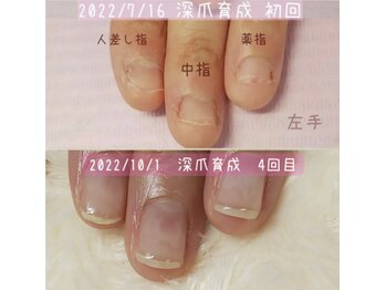 ネイルリラ(Nail-Lilas)の写真/深爪悩みを卒業！深爪育成で憧れの美しい指先へ導きます♪