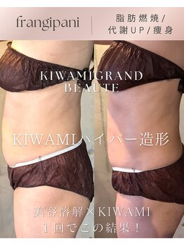 フランジパニ(FRANGIPANI)の写真/減量成功実績◎お客様のスタイルに合わせたご提案♪セル脂肪燃焼効果高い最新マシンで理想のボディラインへ