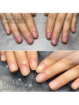 ネイルサロン あんび/深爪矯正