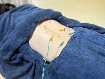 トイ鍼灸接骨院(TOY鍼灸接骨院)/●鍼灸