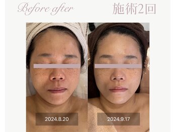 パルタージュ(Partage)/ノーニードルエアジェアット導入