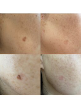 アロマエステサロン エッセンス/シミケア